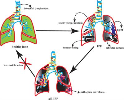 Potential targeted therapy based on deep insight into the relationship between the pulmonary microbiota and immune regulation in lung fibrosis